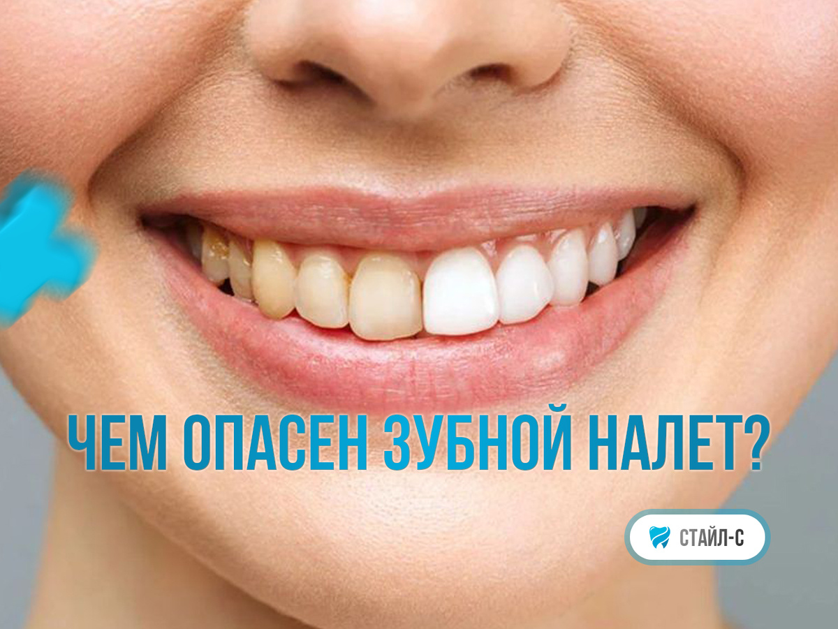 Опасности зубного налета