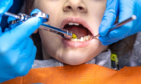 В Петрозаводске стоматолог во время приема потерял иглу в желудке девятилетней пациентки