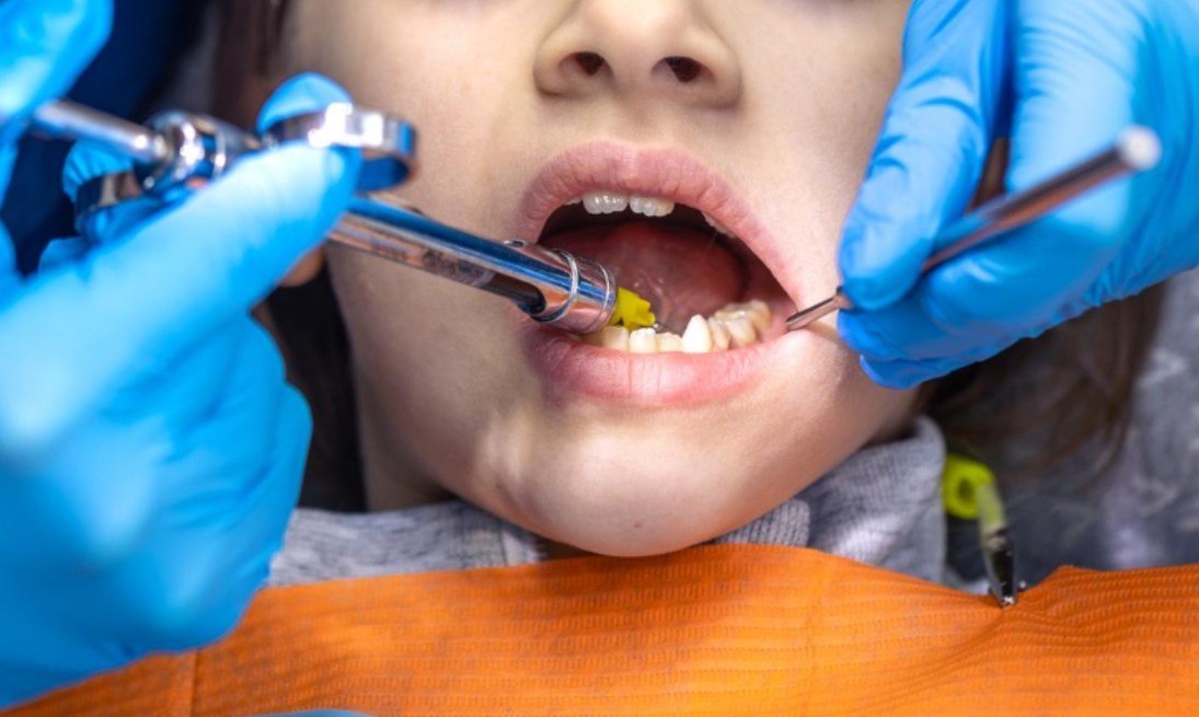 В Петрозаводске стоматолог во время приема потерял иглу в желудке девятилетней пациентки